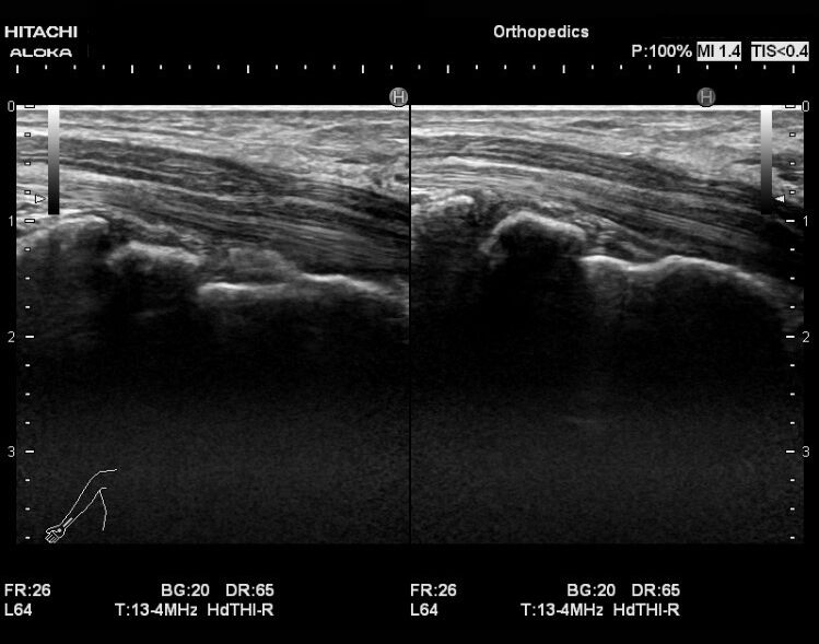 手根管を避けるための携帯電話の持ち方は?
